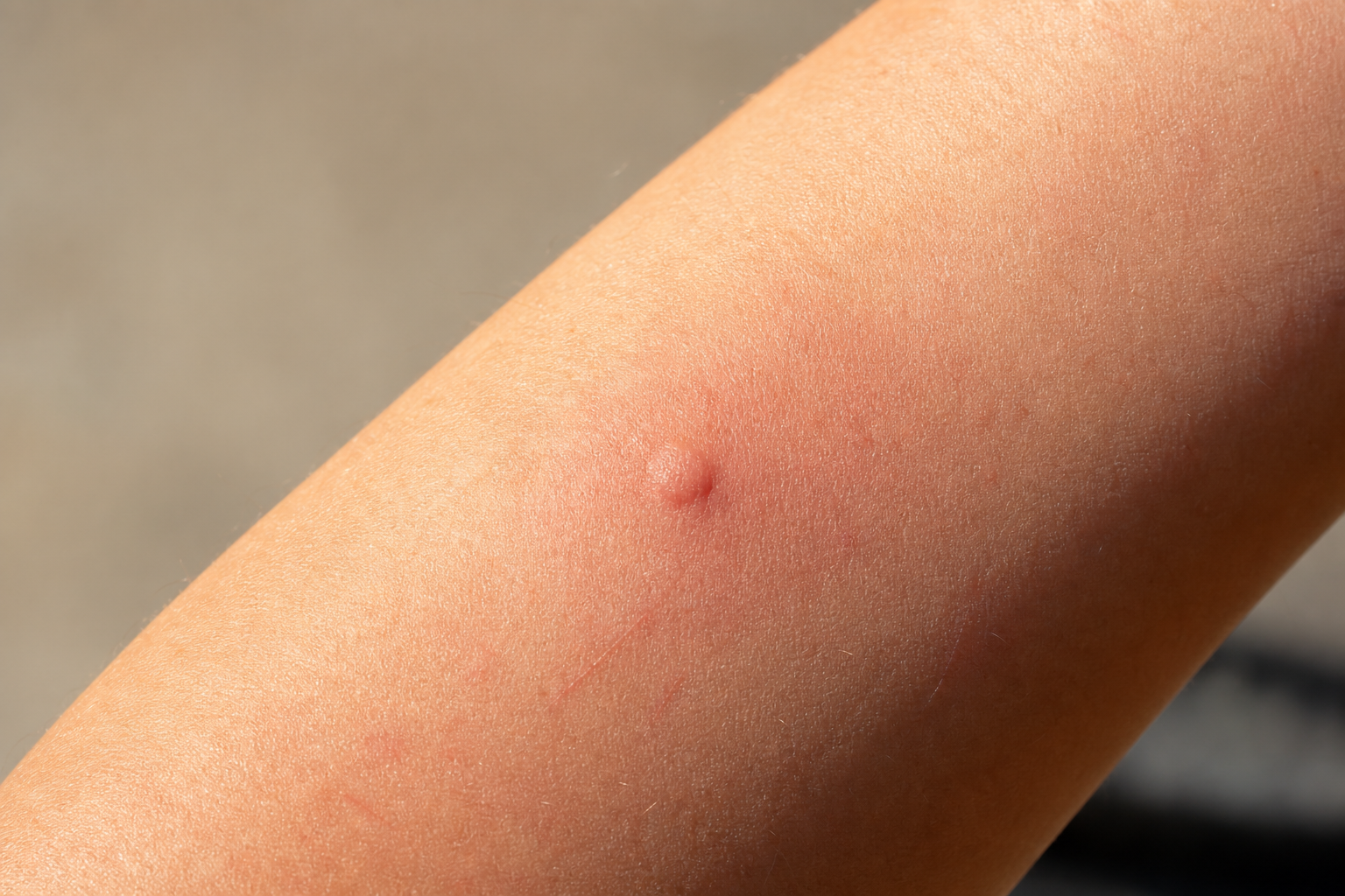 Itchy Mosquito Bite on Arm