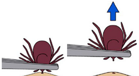 tick removal with tweezers